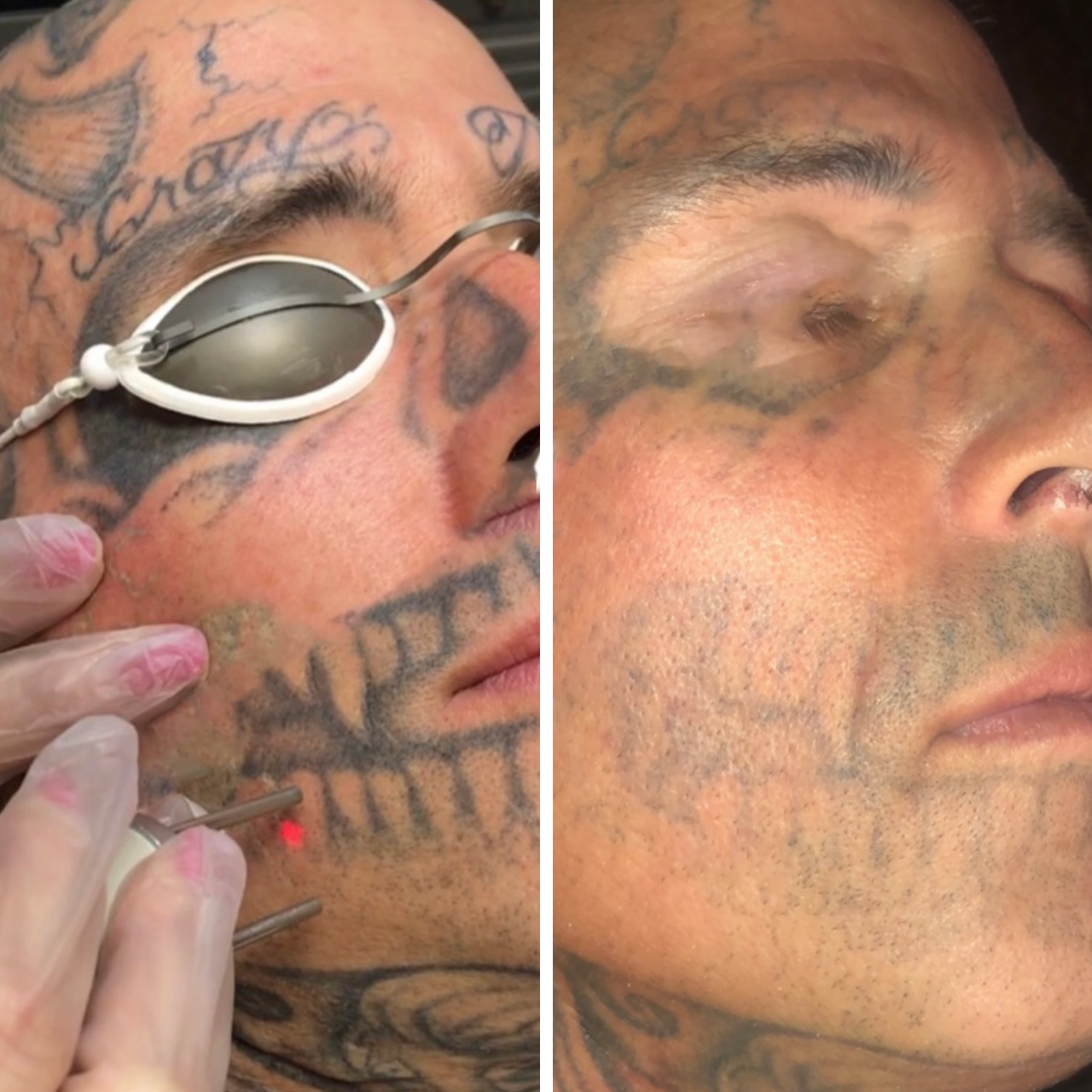 Laser tattoo removal before and after result 1