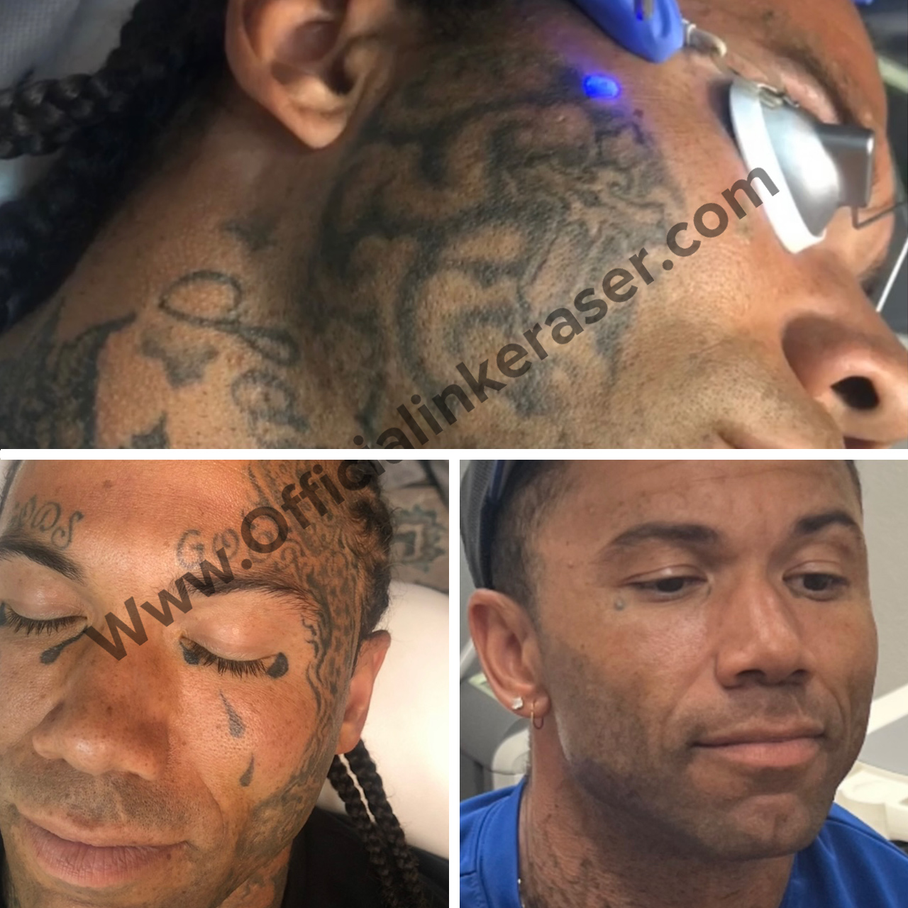 Laser tattoo removal before and after result 2