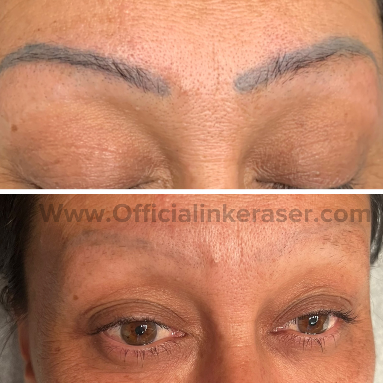 Laser tattoo removal before and after result 3