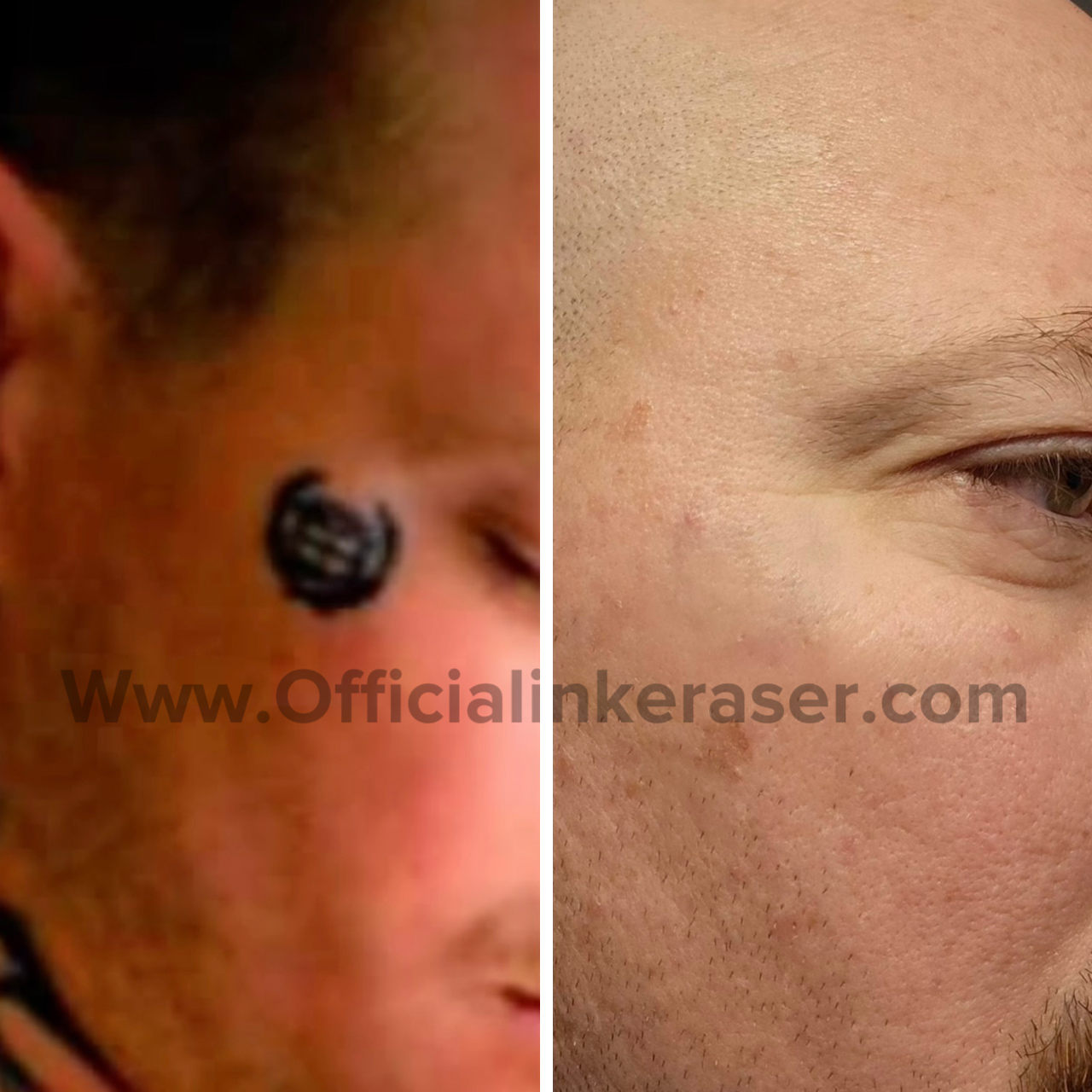 Laser tattoo removal before and after result 4