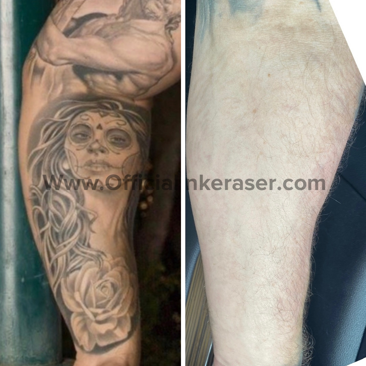 Laser tattoo removal before and after result 5