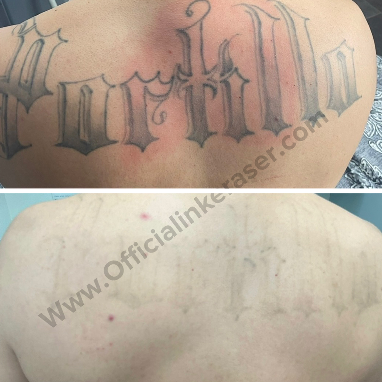 Laser tattoo removal before and after result 6