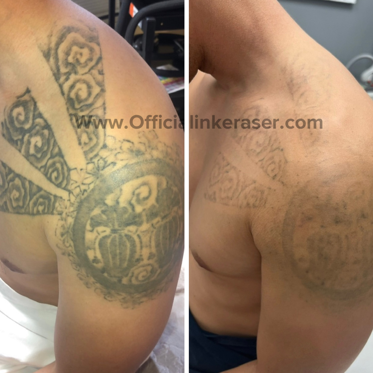 Laser tattoo removal before and after result 7