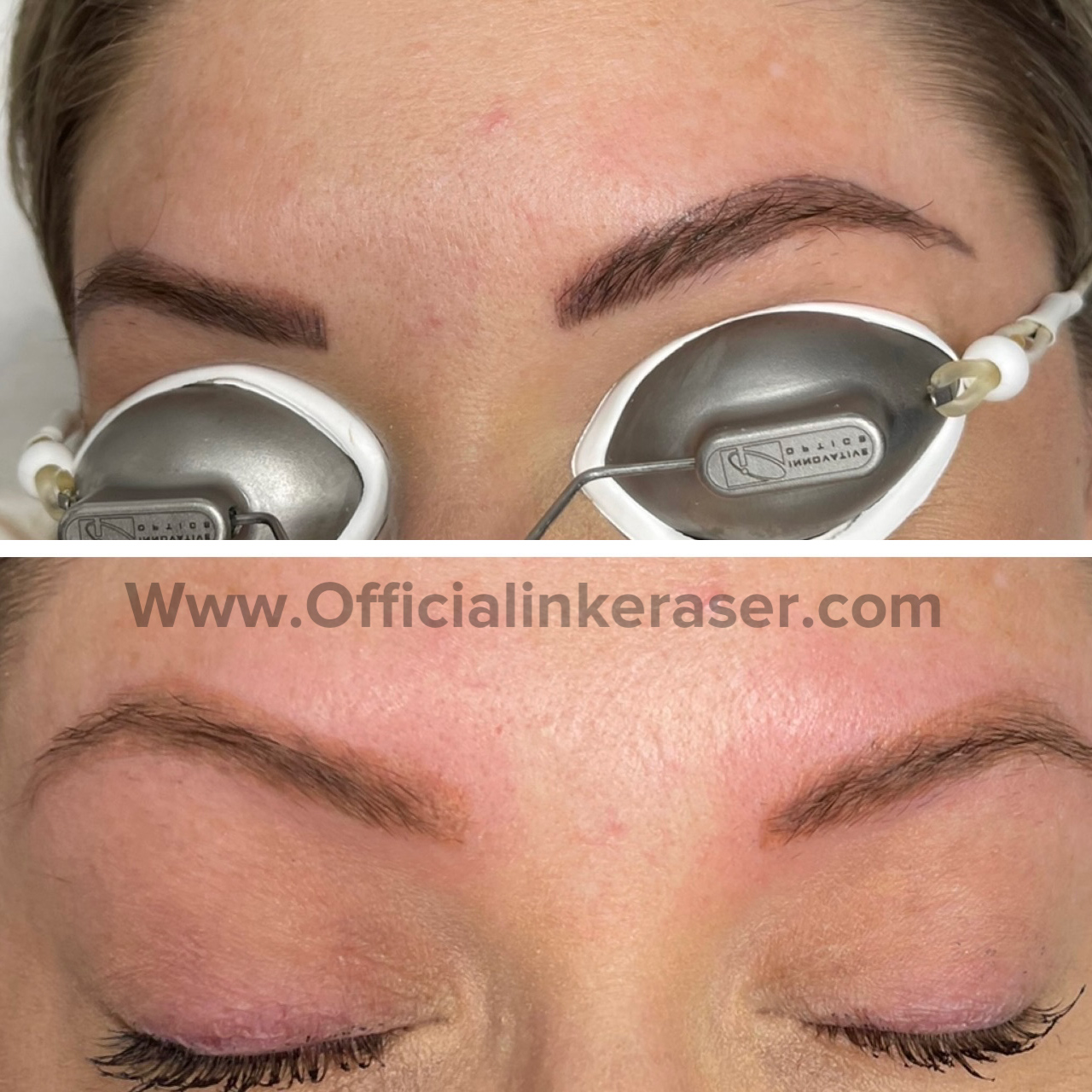 Laser tattoo removal before and after result 8