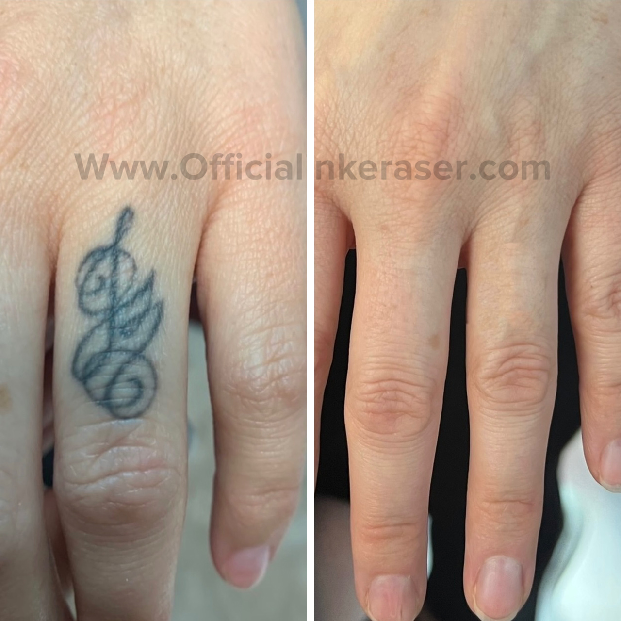 Laser tattoo removal before and after result 9